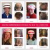 iRestore Essential Laser Hair Growth System - FDA Cleared Hair Loss Treatments for Men & Women & Hair Growth Products for Men with Thinning Hair, Hair Regrowth Treatments Laser Cap, Red Light Therapy